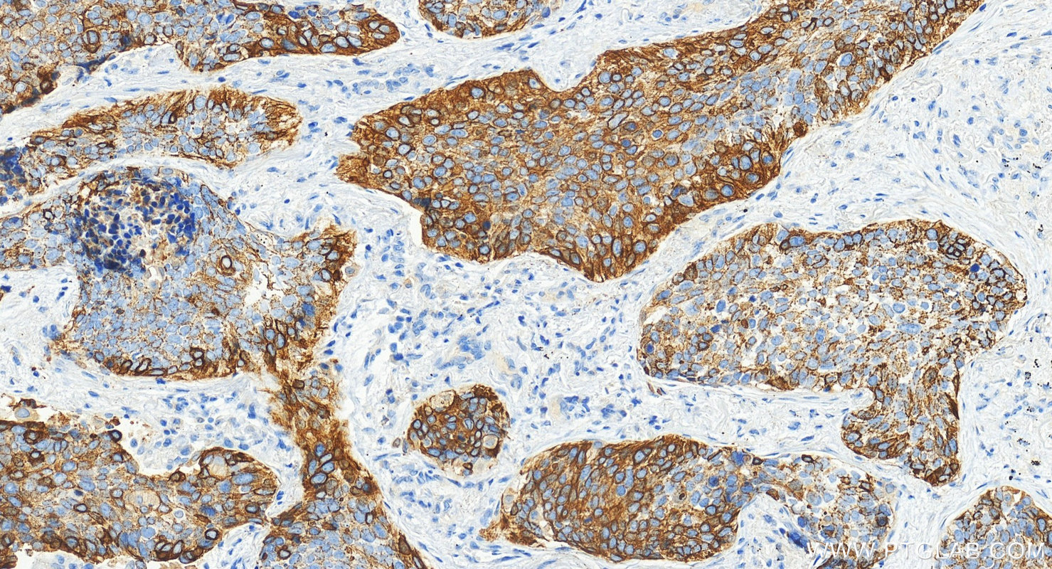 IHC staining of human lung squamous cell carcinoma using 10143-1-AP