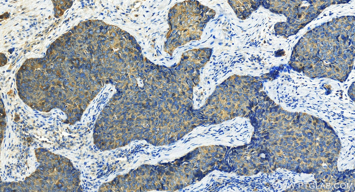 IHC staining of human bowen disease using 22221-1-AP