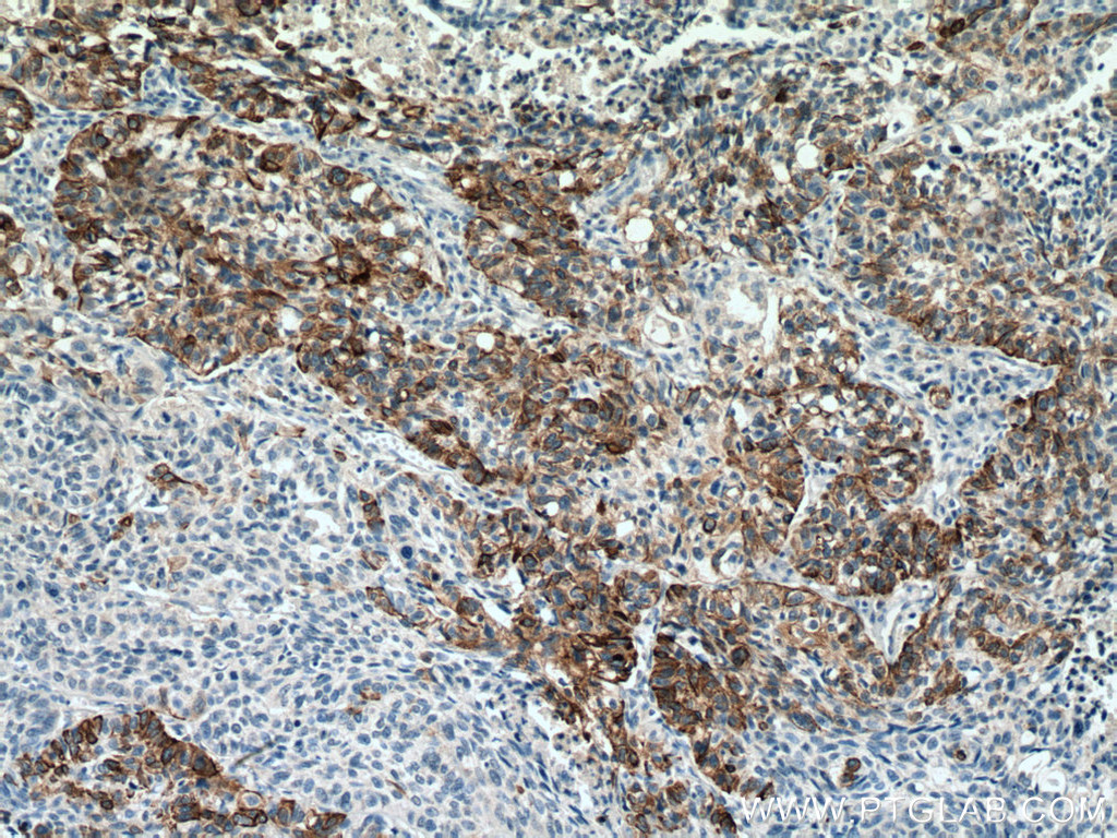 IHC staining of human lung cancer using 60320-1-Ig