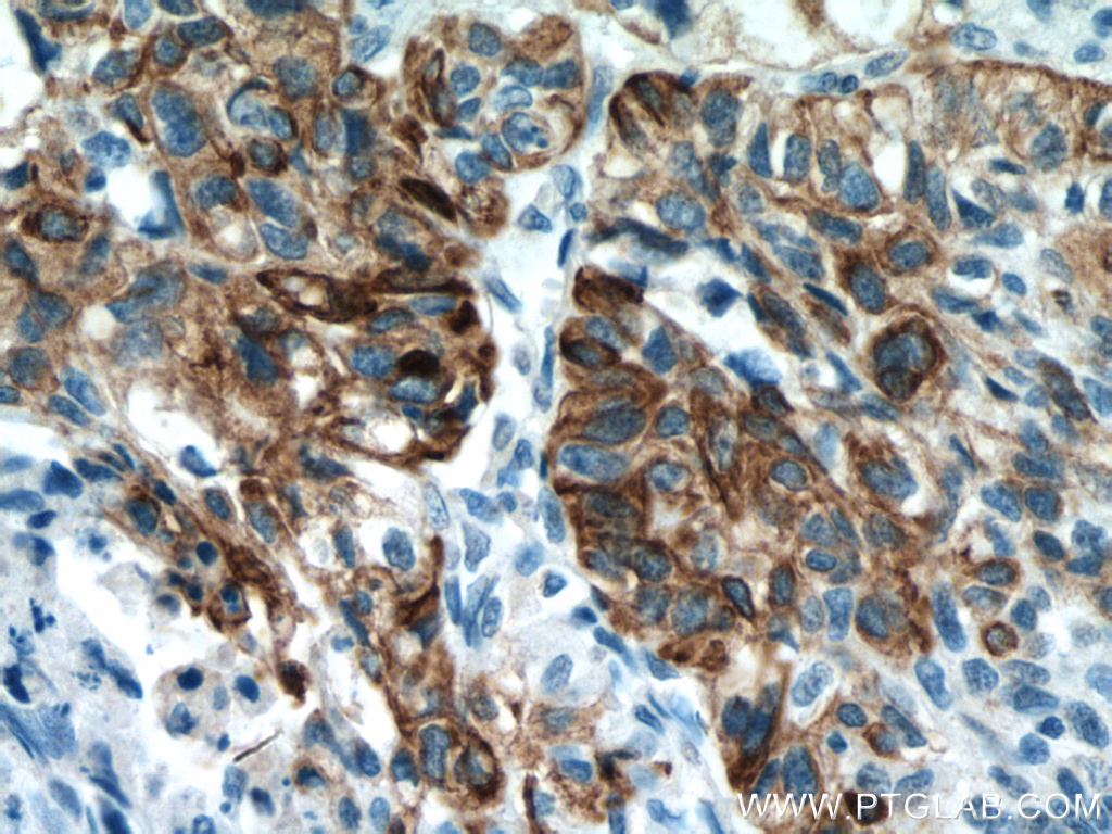 IHC staining of human lung cancer using 60320-1-Ig