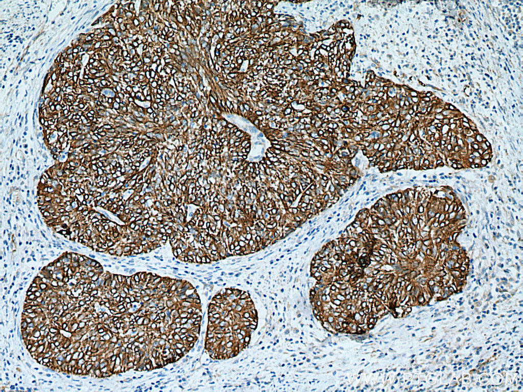 IHC staining of human cervical cancer using 10137-1-AP