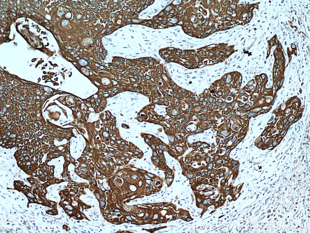 IHC staining of human oesophagus cancer using 60247-1-Ig (same clone as 60247-1-PBS)
