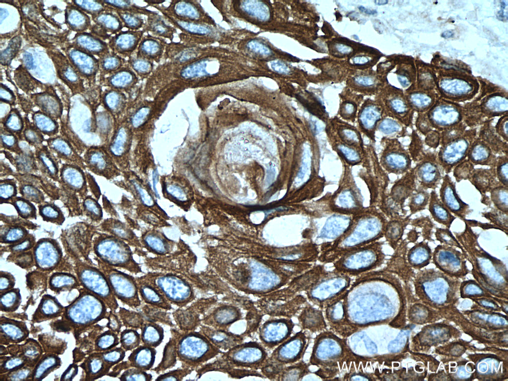 IHC staining of human oesophagus cancer using 60247-1-Ig (same clone as 60247-1-PBS)
