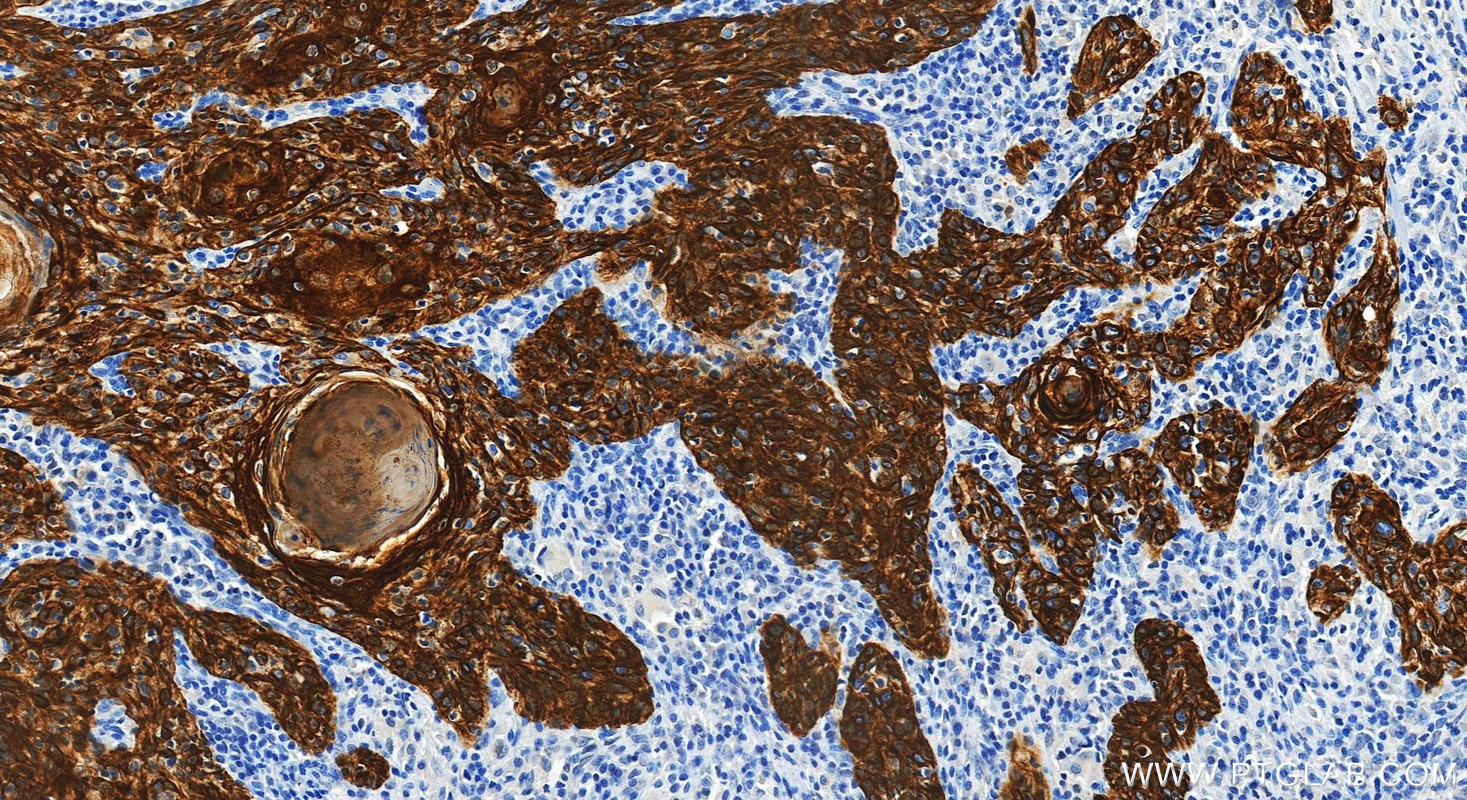 Immunohistochemical analysis of paraffin-embedded human skin cancer tissue slide using 60247-1-Ig (Cytokeratin 15 antibody) at dilution of 1:4000 (under 20x lens). Heat mediated antigen retrieval with Tris-EDTA buffer (pH 9.0). IHC staining of human skin cancer using 60247-1-Ig