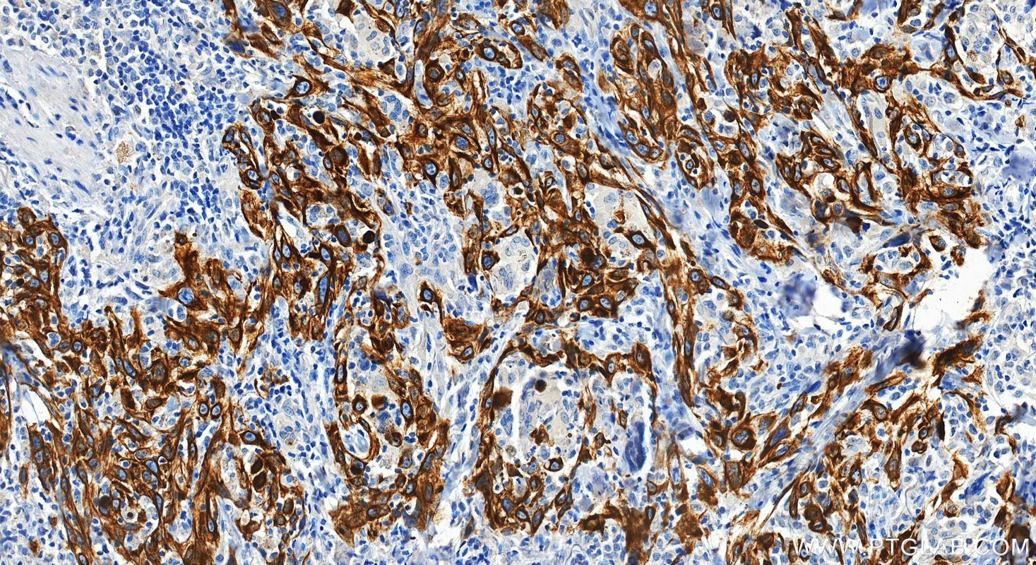 Immunohistochemical analysis of paraffin-embedded human skin cancer tissue slide using 60247-1-Ig (Cytokeratin 15 antibody) at dilution of 1:4000 (under 20x lens). Heat mediated antigen retrieval with Tris-EDTA buffer (pH 9.0). IHC staining of human skin cancer using 60247-1-Ig