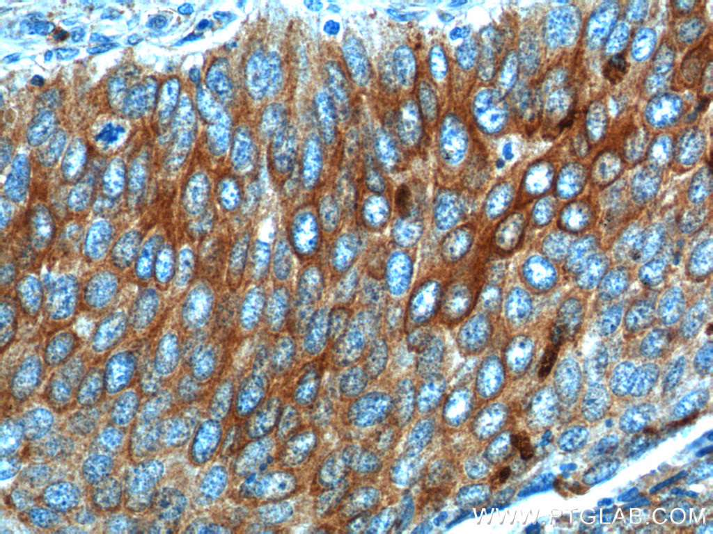 IHC staining of human cervical cancer using 18502-1-AP