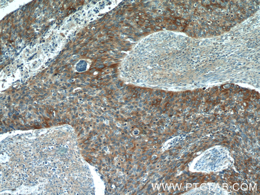 IHC staining of human cervical cancer using 22230-1-AP