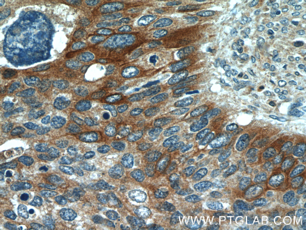 IHC staining of human cervical cancer using 22230-1-AP