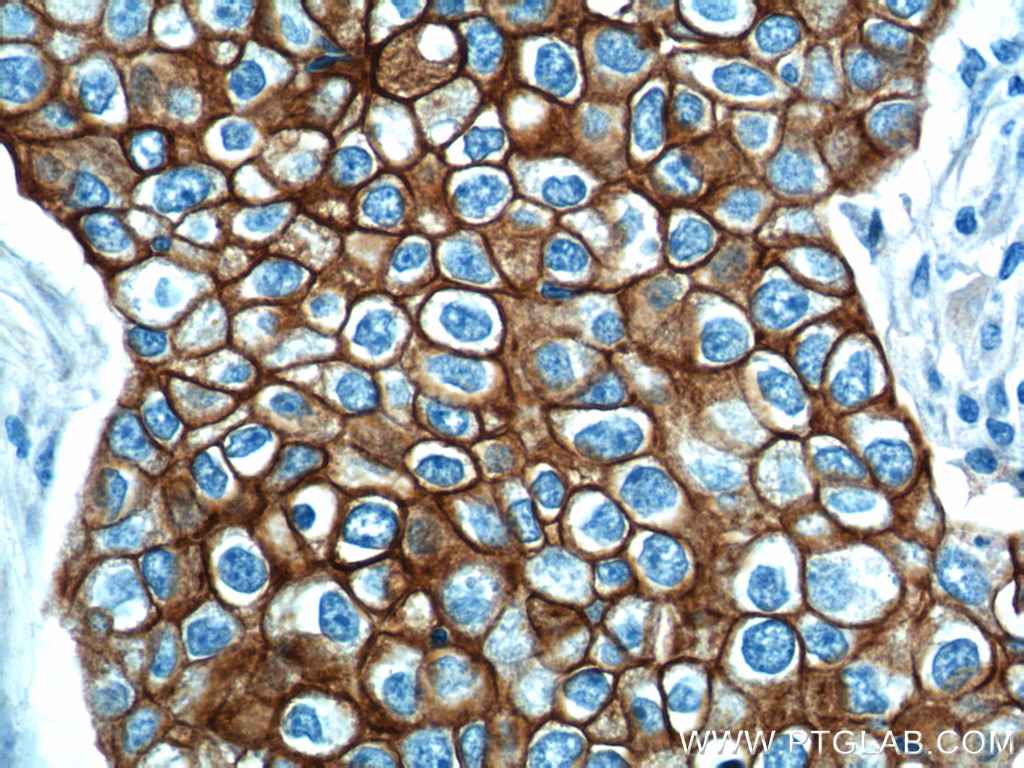 IHC staining of human breast cancer using 10830-1-AP