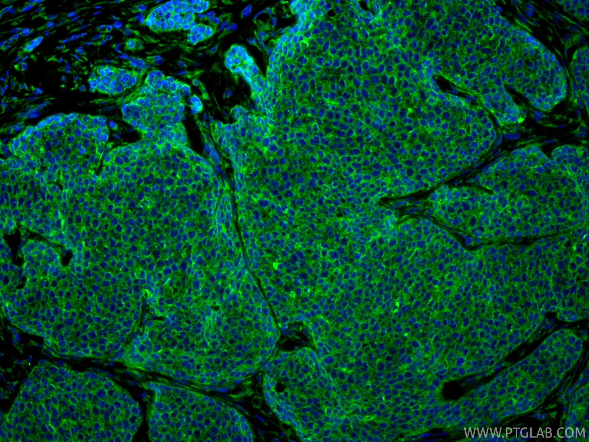 IF Staining of human breast cancer using 18708-1-AP IF Staining of human breast cancer using 18708-1-AP