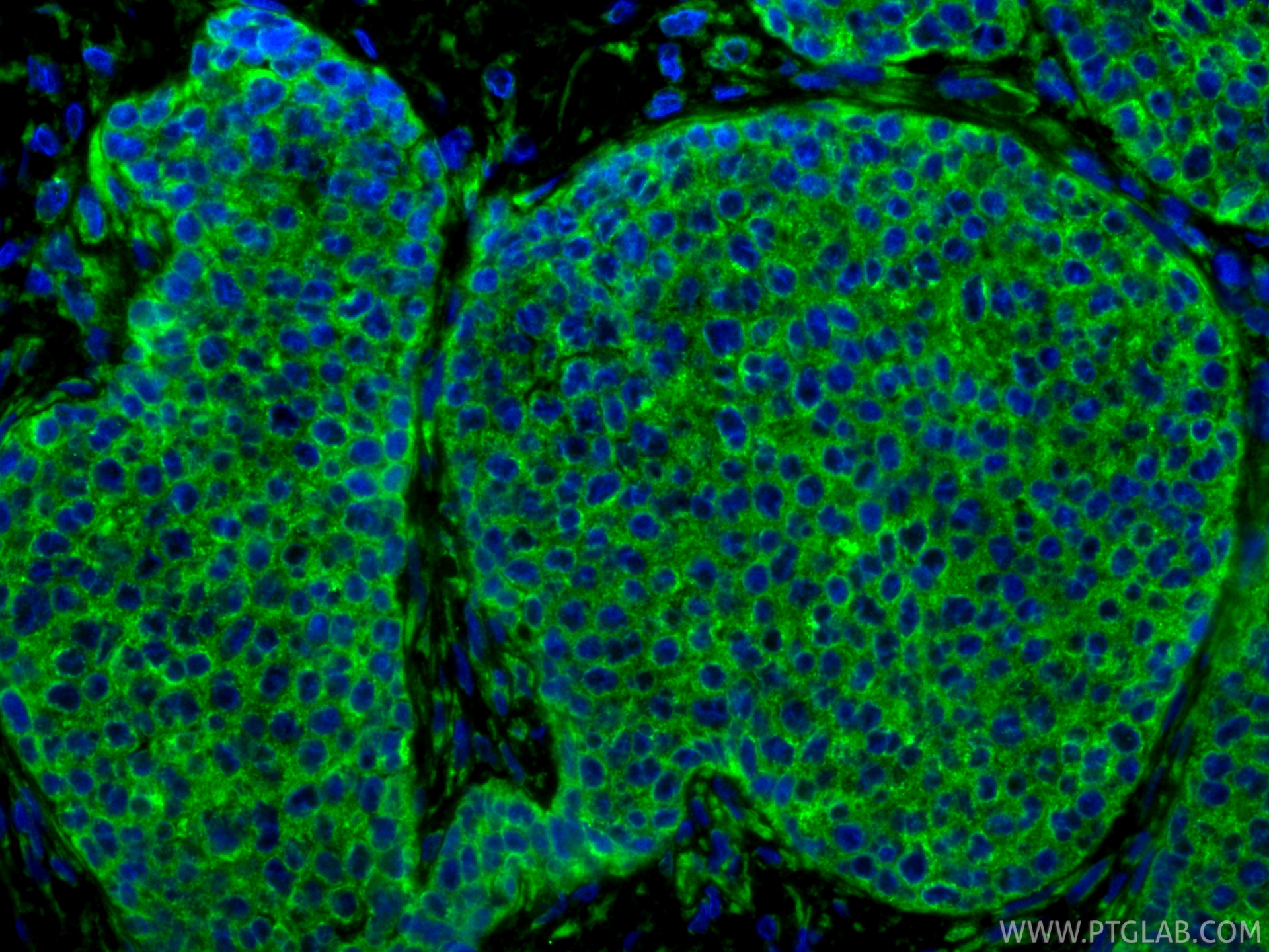 IF Staining of human breast cancer using 18708-1-AP IF Staining of human breast cancer using 18708-1-AP
