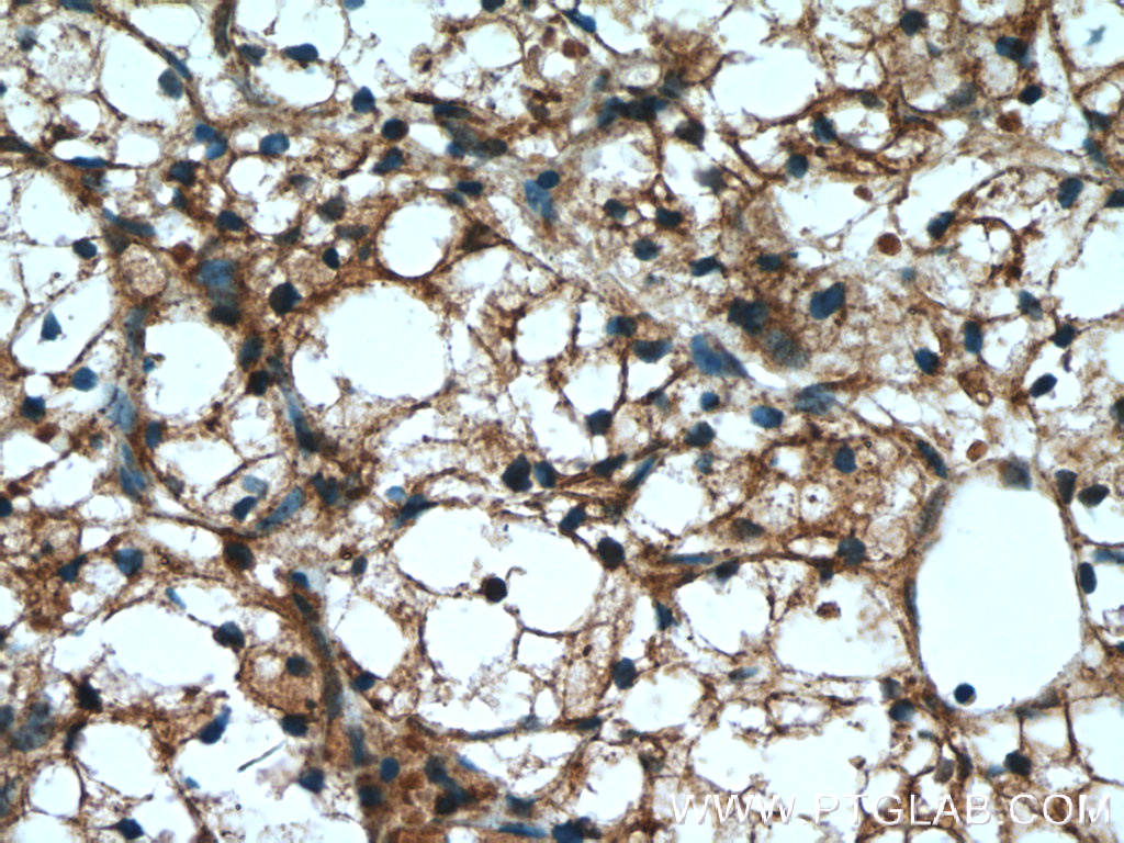 IHC staining of human renal cell carcinoma using 18708-1-AP