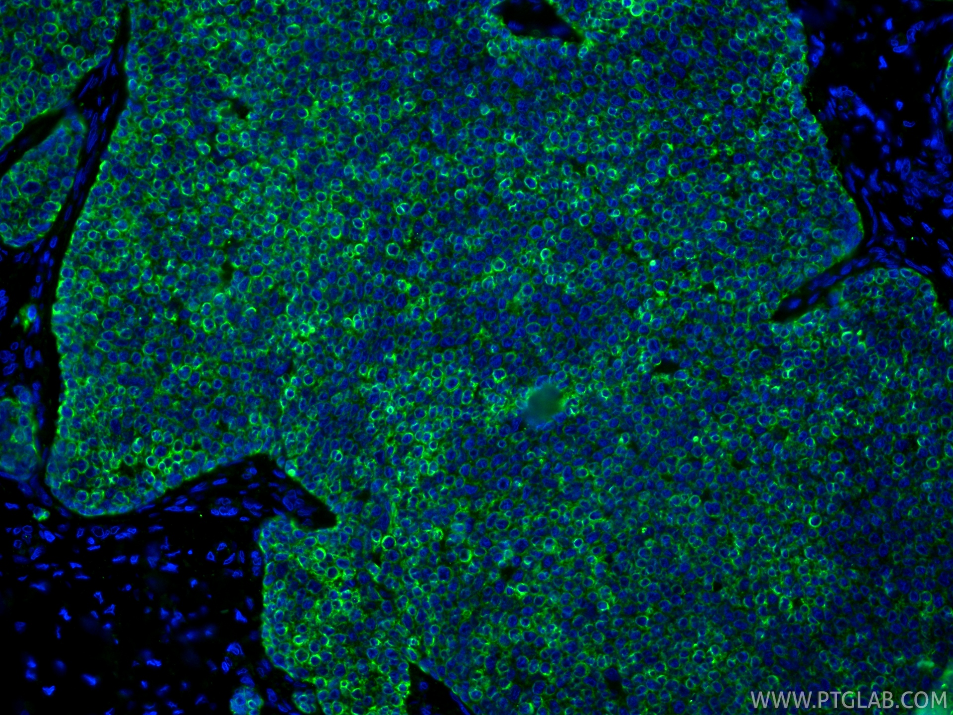 IF Staining of human breast cancer using 66187-1-Ig IF Staining of human breast cancer using 66187-1-Ig