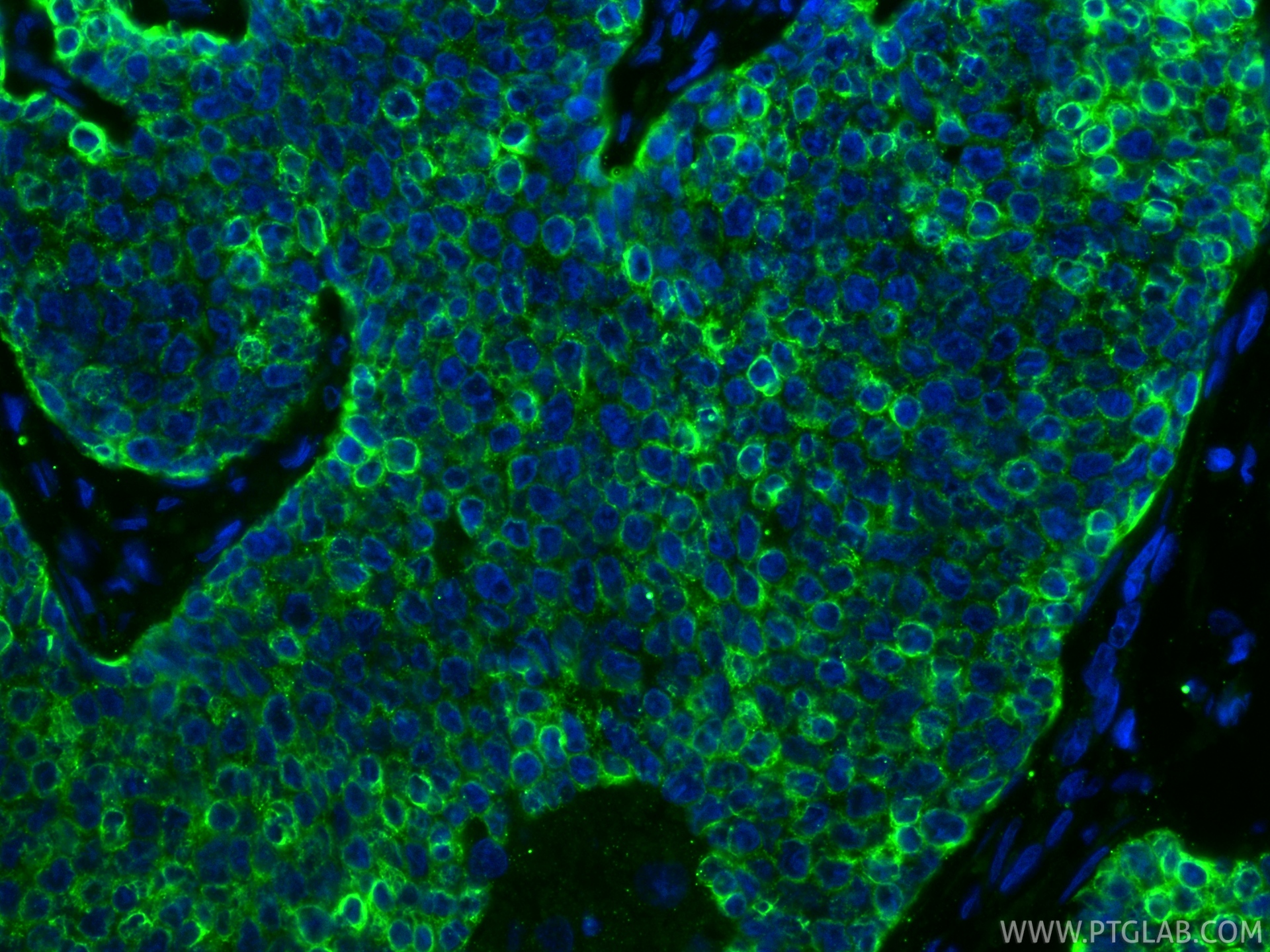 IF Staining of human breast cancer using 66187-1-Ig IF Staining of human breast cancer using 66187-1-Ig
