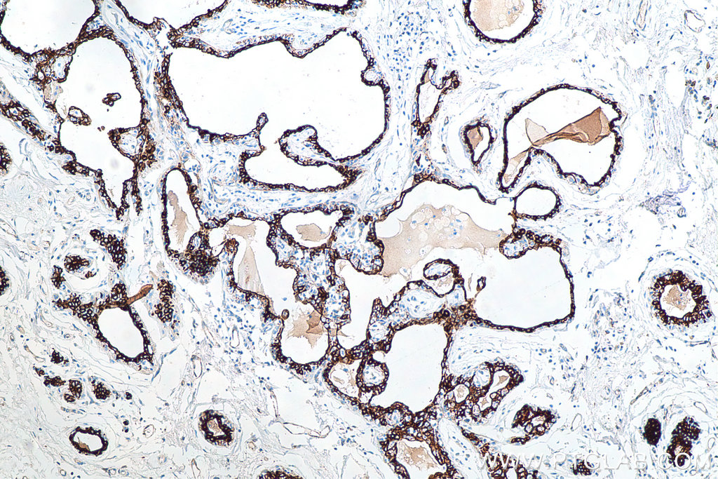 IHC staining of human breast cancer using 66187-1-Ig IHC staining of human breast cancer using 66187-1-Ig