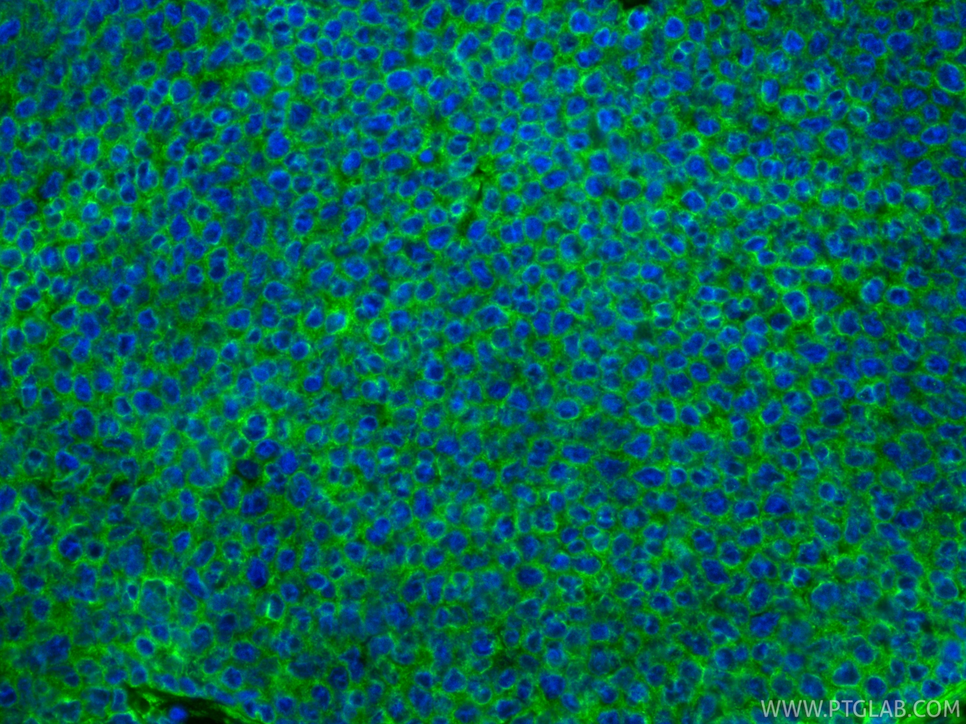 IF Staining of human breast cancer using 82817-5-RR IF Staining of human breast cancer using 82817-5-RR