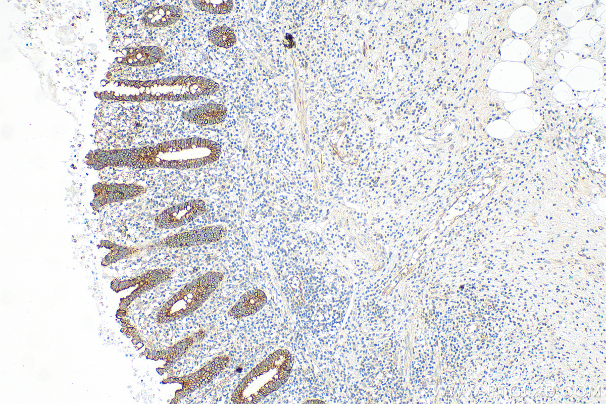 IHC staining of human appendicitis using 82817-5-RR