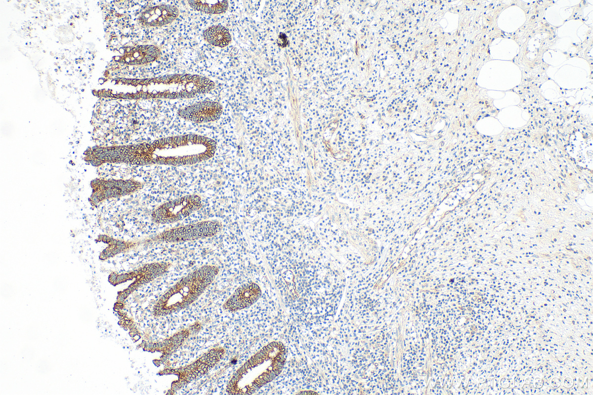 IHC staining of human appendicitis using 82817-5-RR (same clone as 82817-5-PBS)