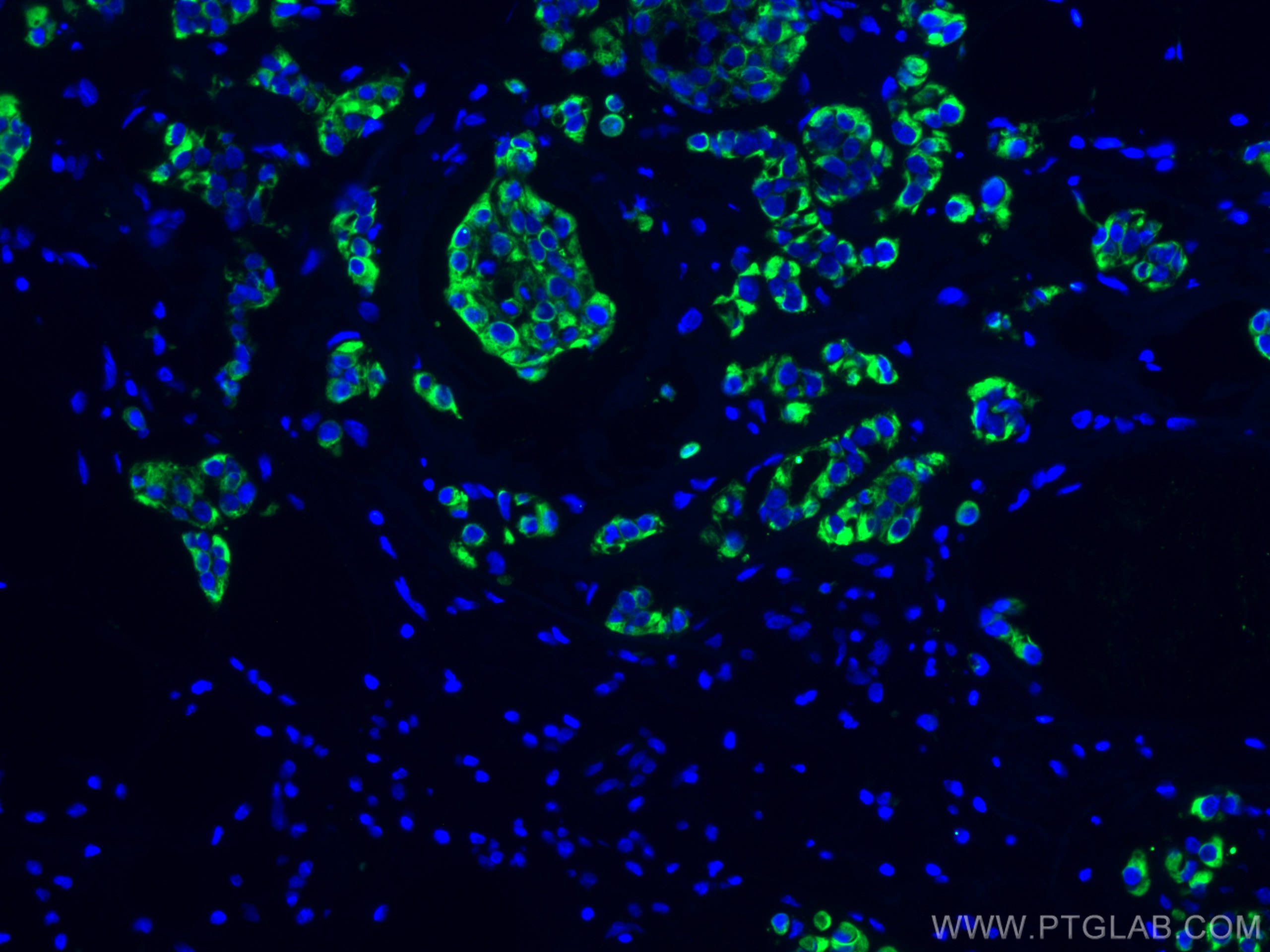 IF Staining of human breast cancer using 60187-1-Ig (same clone as 60187-1-PBS)