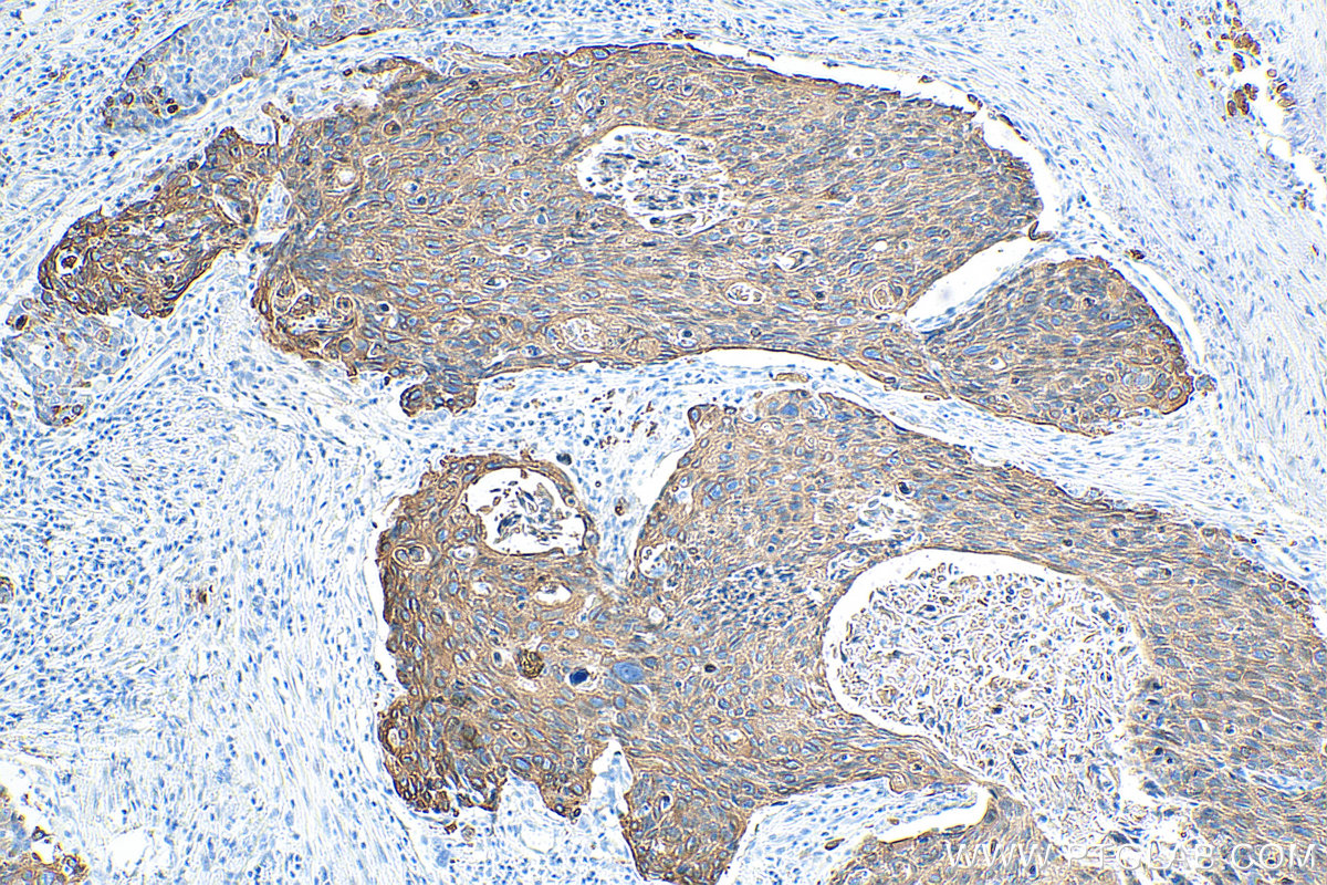 IHC staining of human oesophagus cancer using 60187-1-Ig (same clone as 60187-1-PBS)