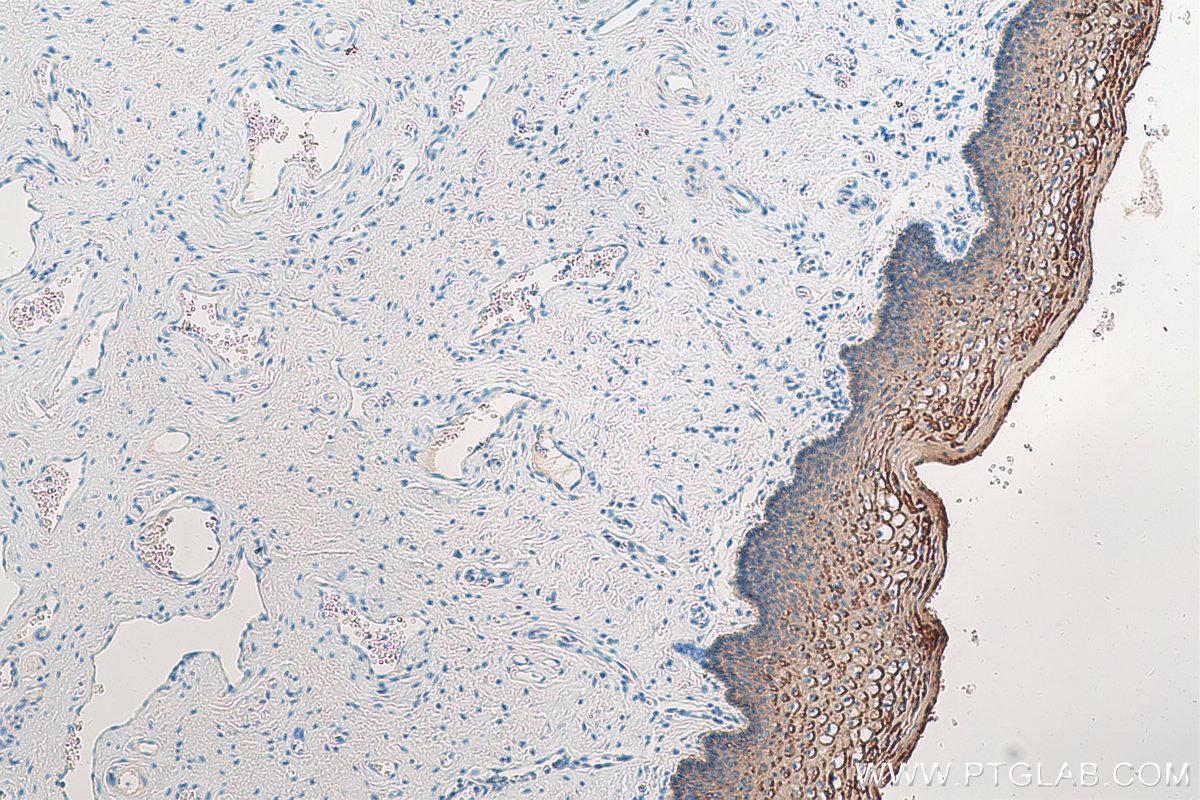 IHC staining of human cervical cancer using 21725-1-AP