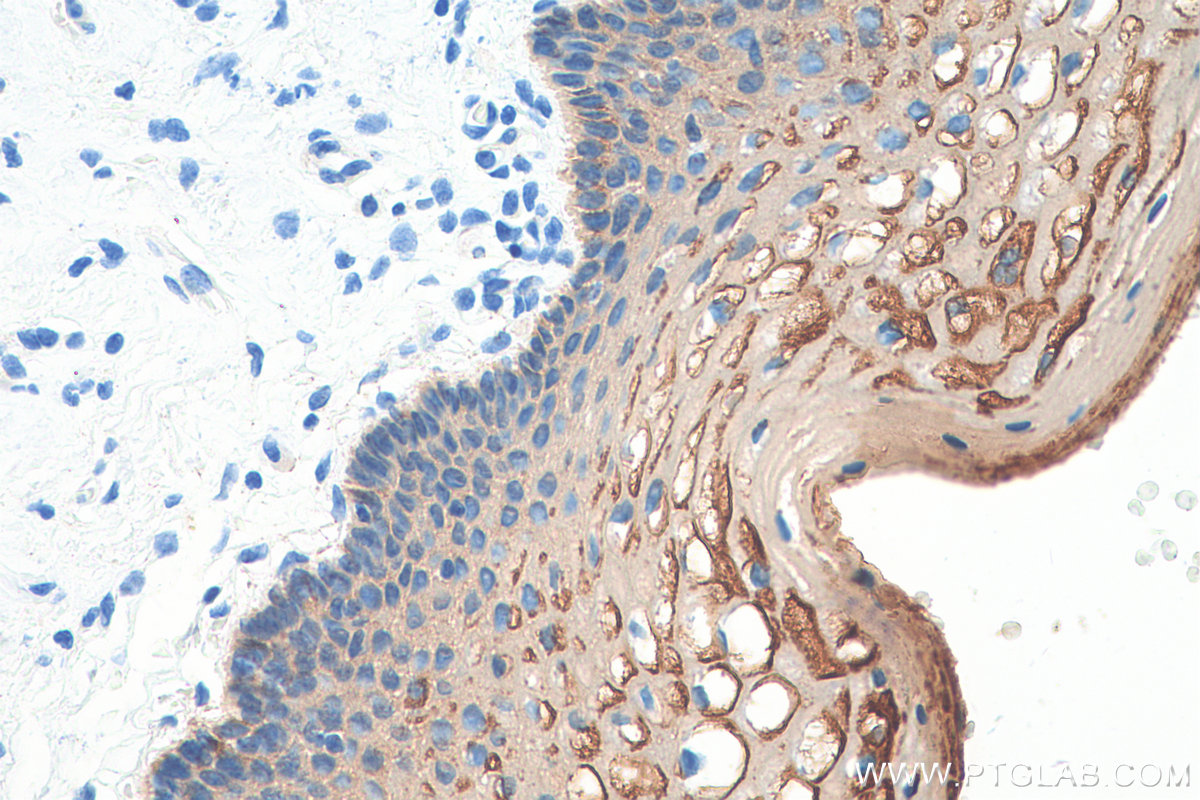 IHC staining of human cervical cancer using 21725-1-AP
