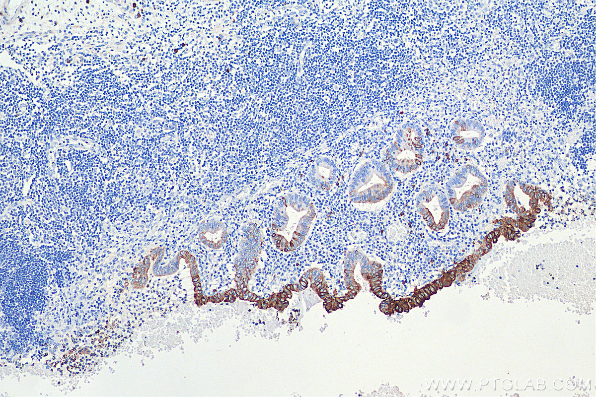 IHC staining of human appendicitis using 17329-1-AP