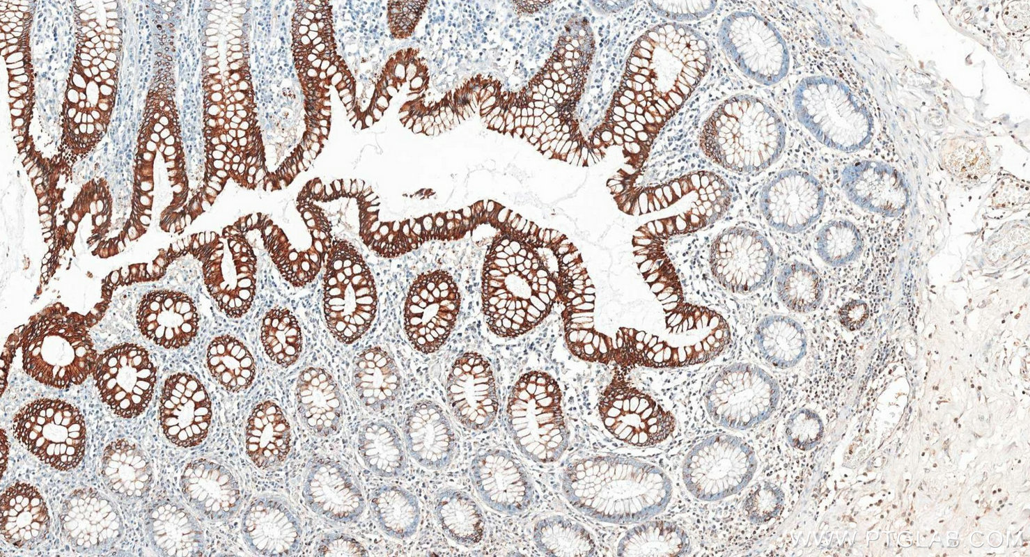 IHC staining of human colon using 17329-1-AP IHC staining of human colon using 17329-1-AP