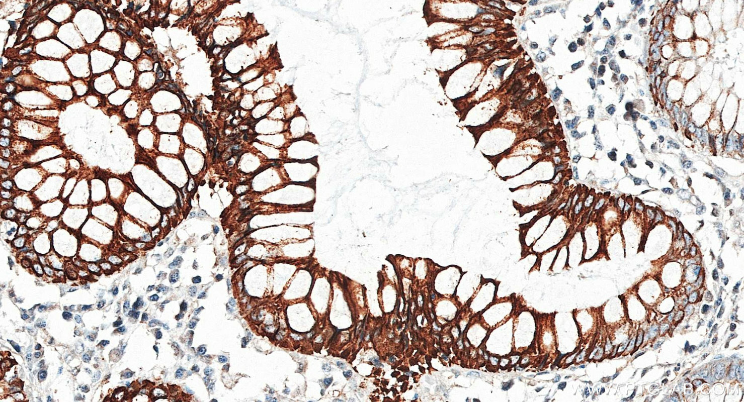 IHC staining of human colon using 17329-1-AP IHC staining of human colon using 17329-1-AP