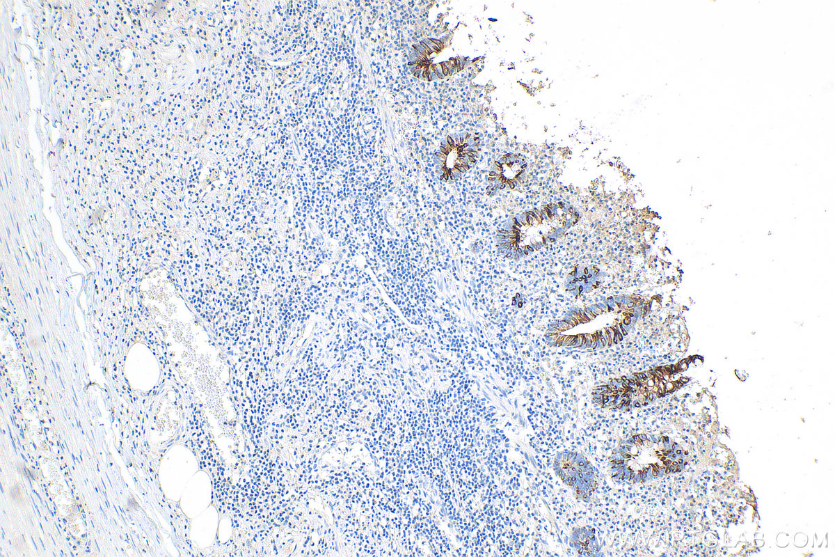 IHC staining of human appendicitis using 82428-1-RR (same clone as 82428-1-PBS)