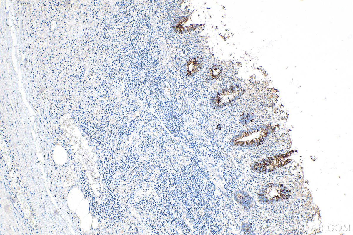 IHC staining of human appendicitis using 82428-1-RR