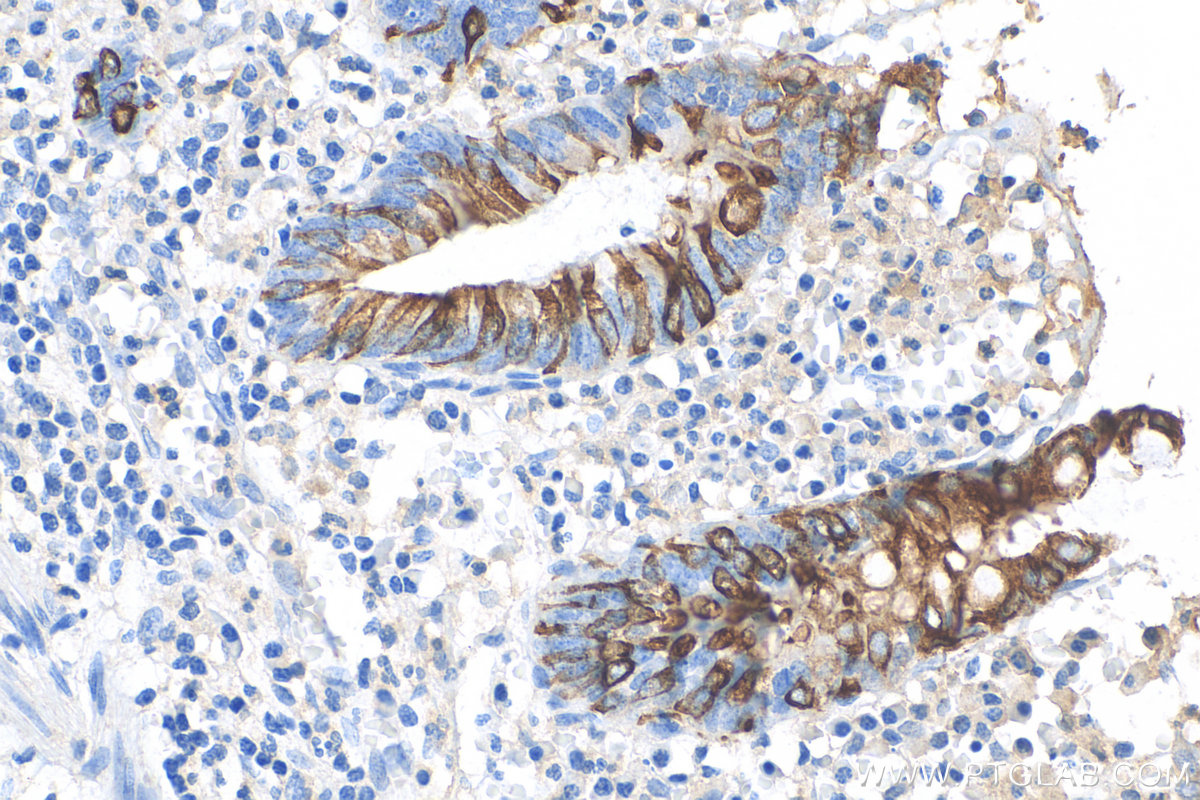 IHC staining of human appendicitis using 82428-1-RR (same clone as 82428-1-PBS)