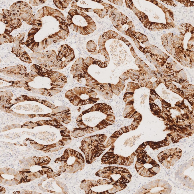 IHC staining of human colorectal cancer using 82428-1-RR