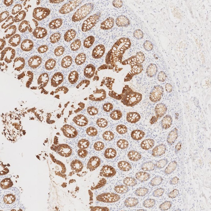 IHC staining of human colorectal cancer using 82428-1-RR
