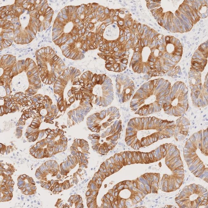 IHC staining of human colorectal cancer using 82428-1-RR
