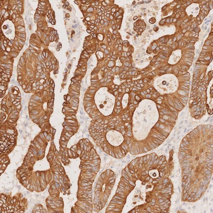 IHC staining of human colorectal cancer using 82428-1-RR