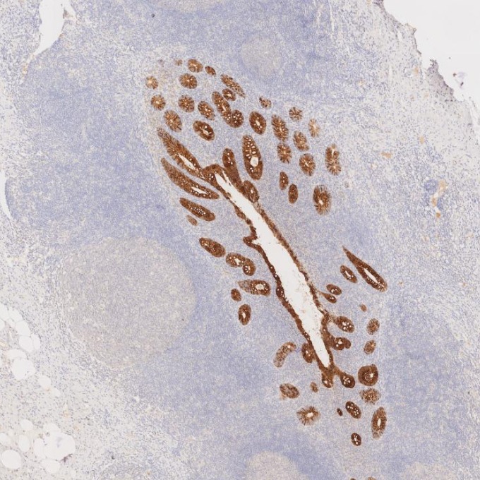 IHC staining of human appendicitis using 82428-1-RR