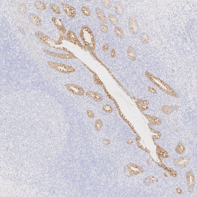 IHC staining of human appendicitis using 82428-1-RR