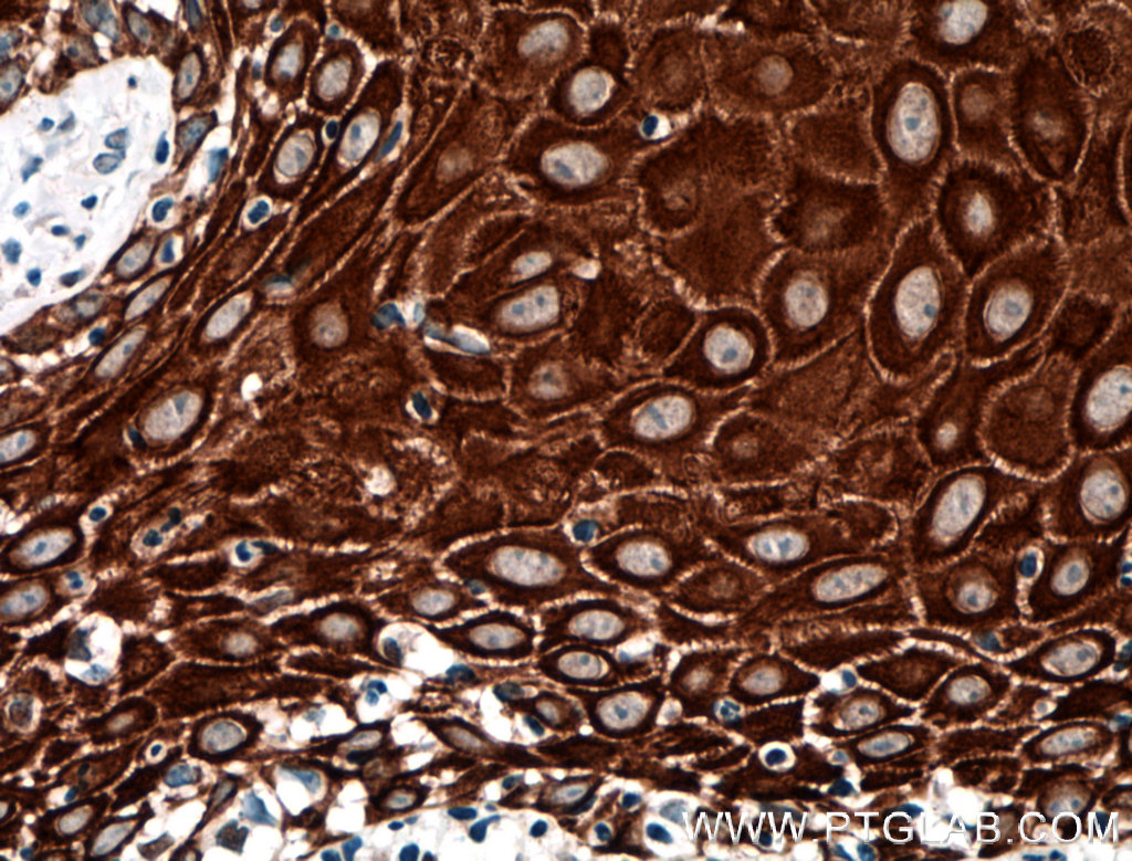 IHC staining of human skin cancer using 11048-1-AP