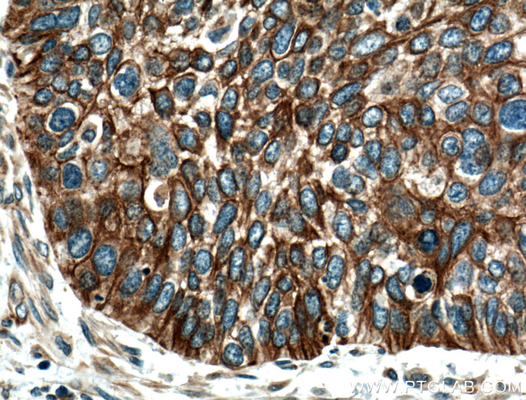 IHC staining of human cervical cancer using 16572-1-AP