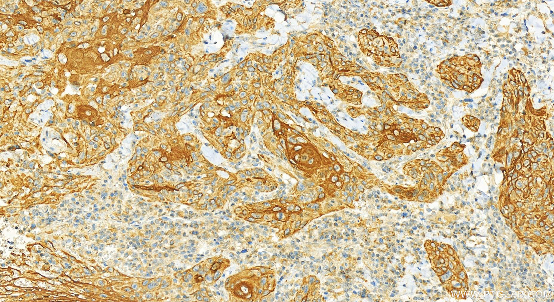 IHC staining of human skin cancer using 16853-1-AP