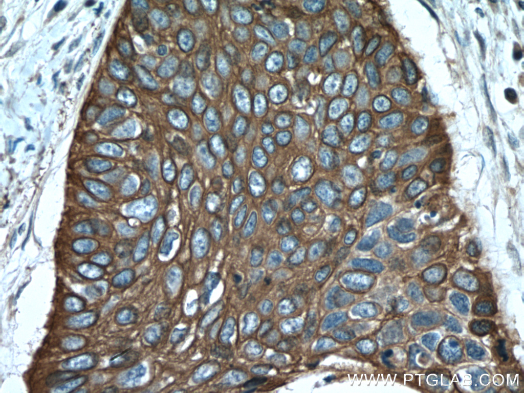 IHC staining of human oesophagus cancer using 10590-1-AP