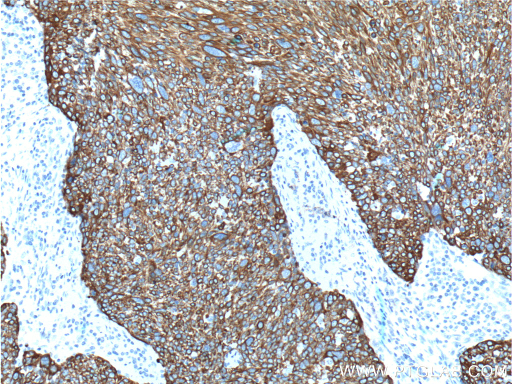 IHC staining of human lung cancer using 17391-1-AP