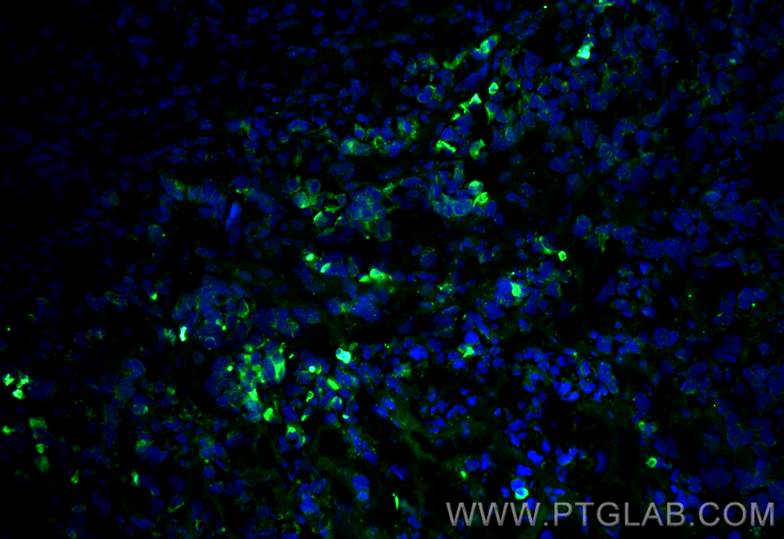 IF Staining of mouse breast cancer using 15539-1-AP