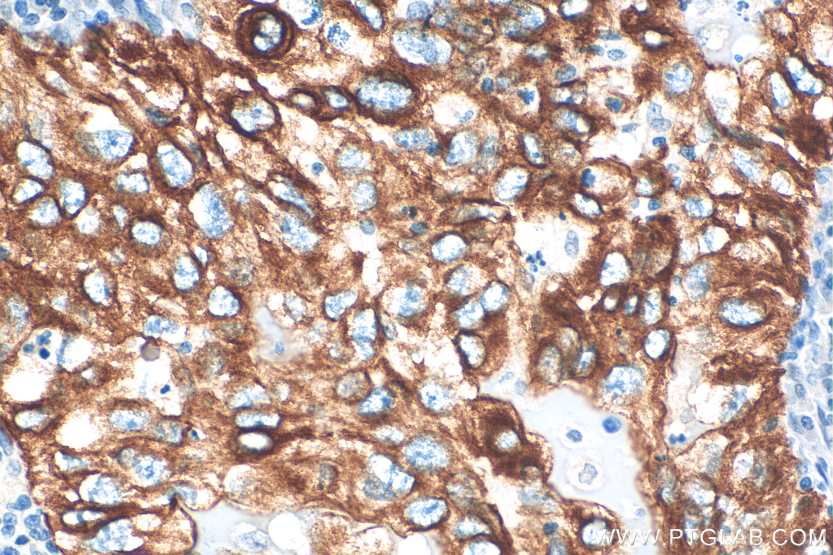 IHC staining of human lung cancer using 17513-1-AP