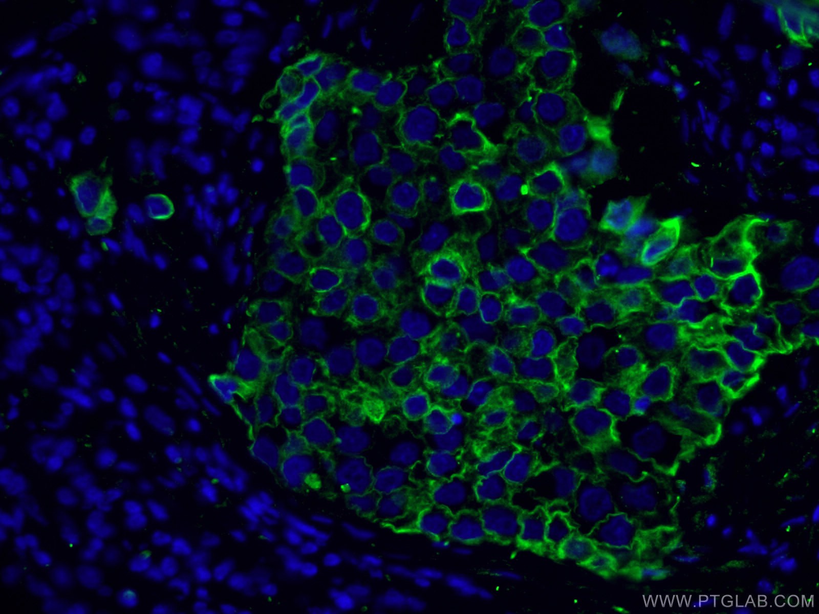 IF Staining of human breast cancer using 10384-1-AP