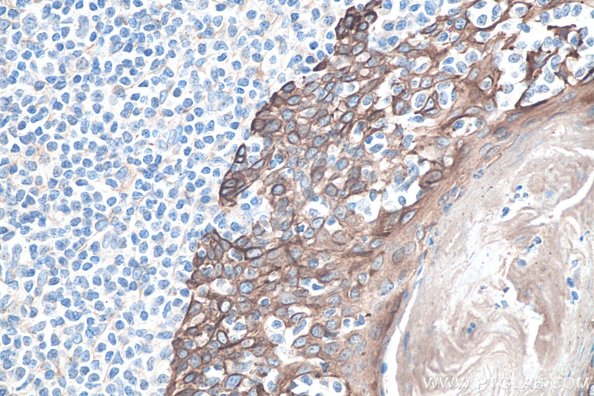 IHC staining of human tonsillitis using 10384-1-AP