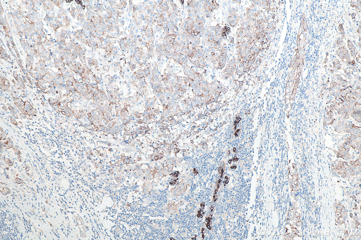 IHC staining of human breast cancer using 10384-1-AP IHC staining of human breast cancer using 10384-1-AP