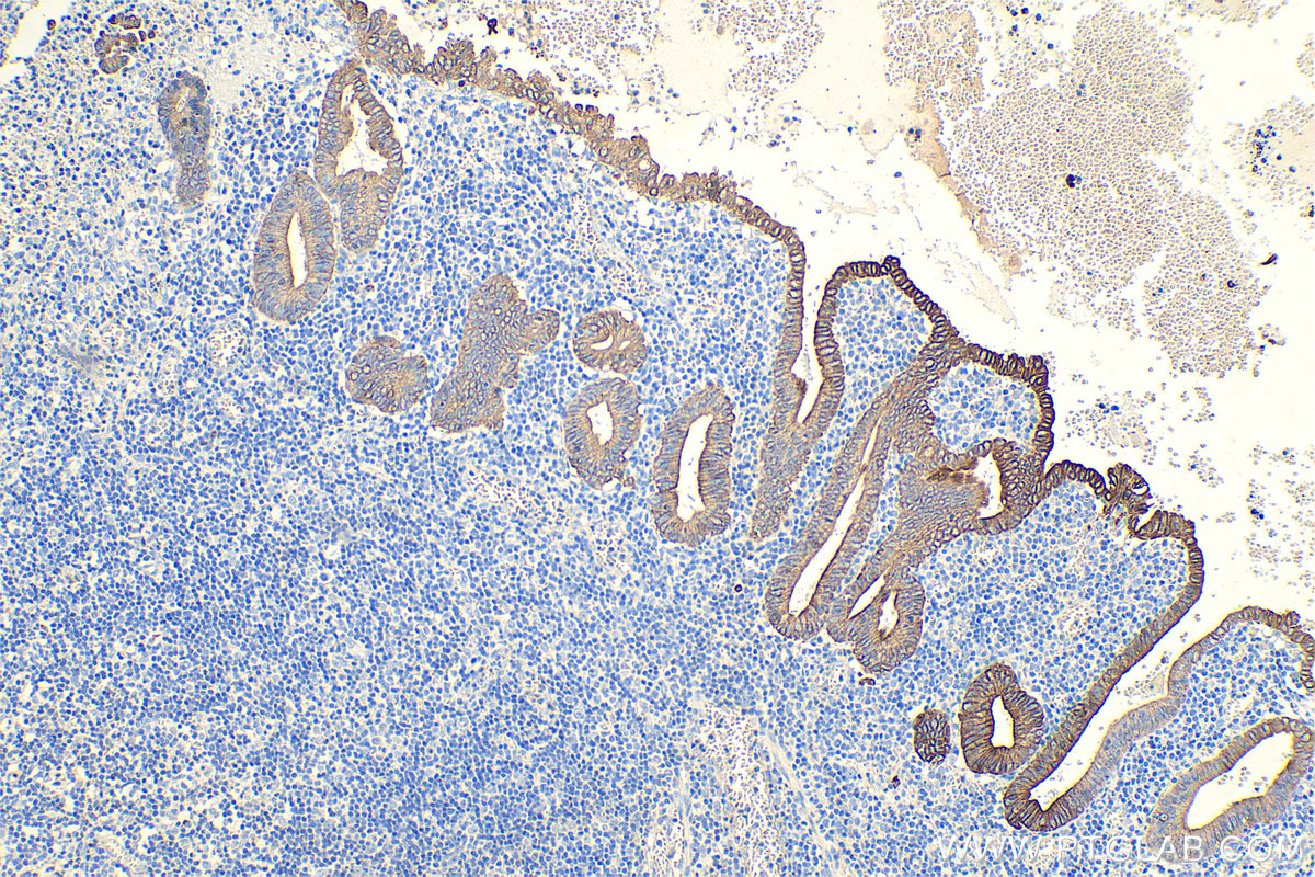 IHC staining of human appendicitis using 10384-1-AP IHC staining of human appendicitis using 10384-1-AP