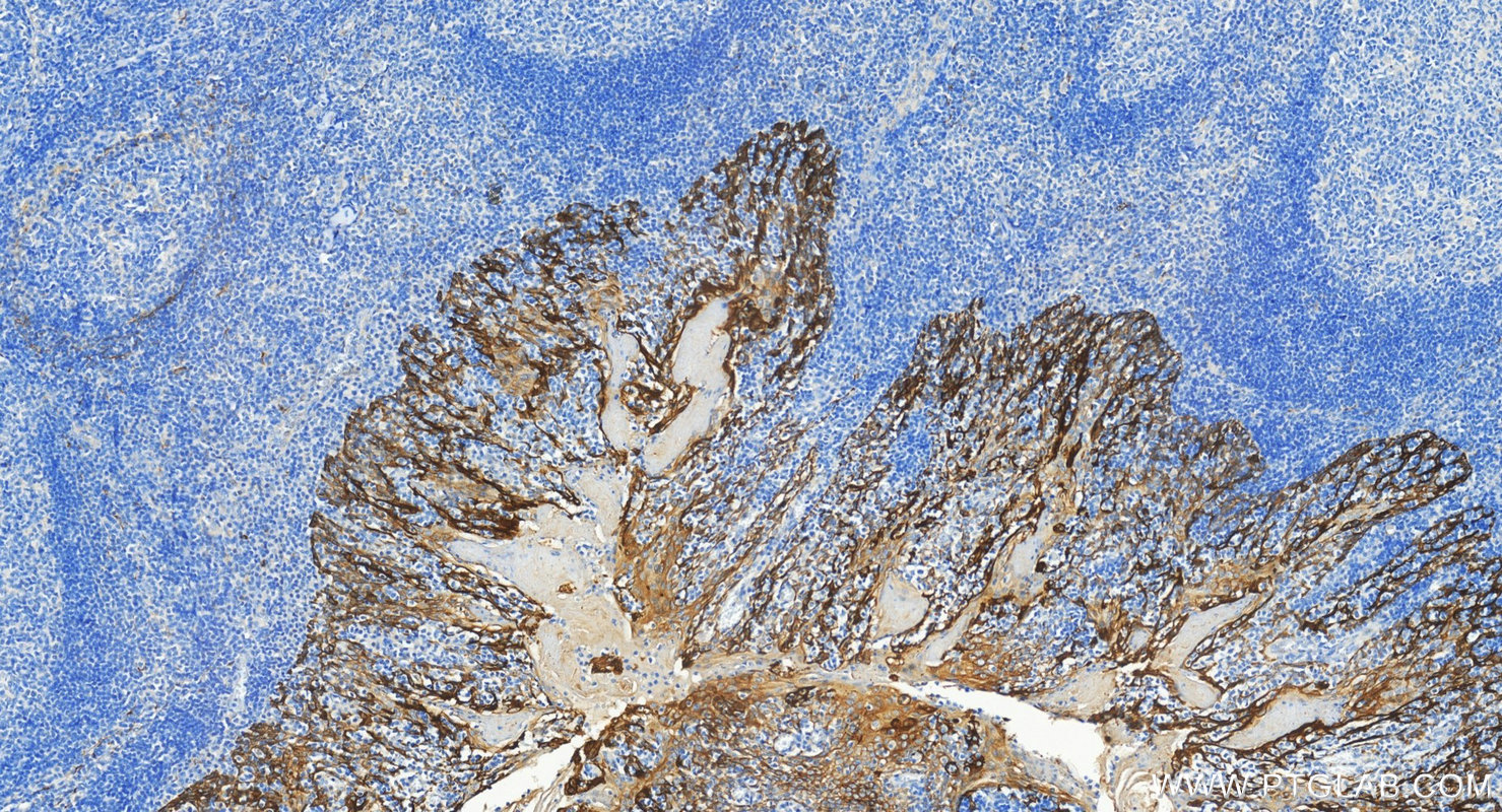 IHC staining of human tonsillitis using 10384-1-AP